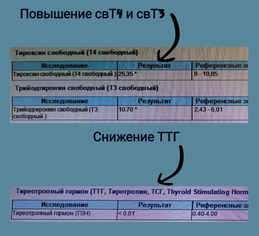 Амиодарон-индуцированный тиреотоксикоз