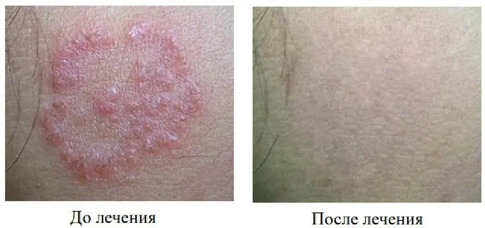 Монетовидная экзема