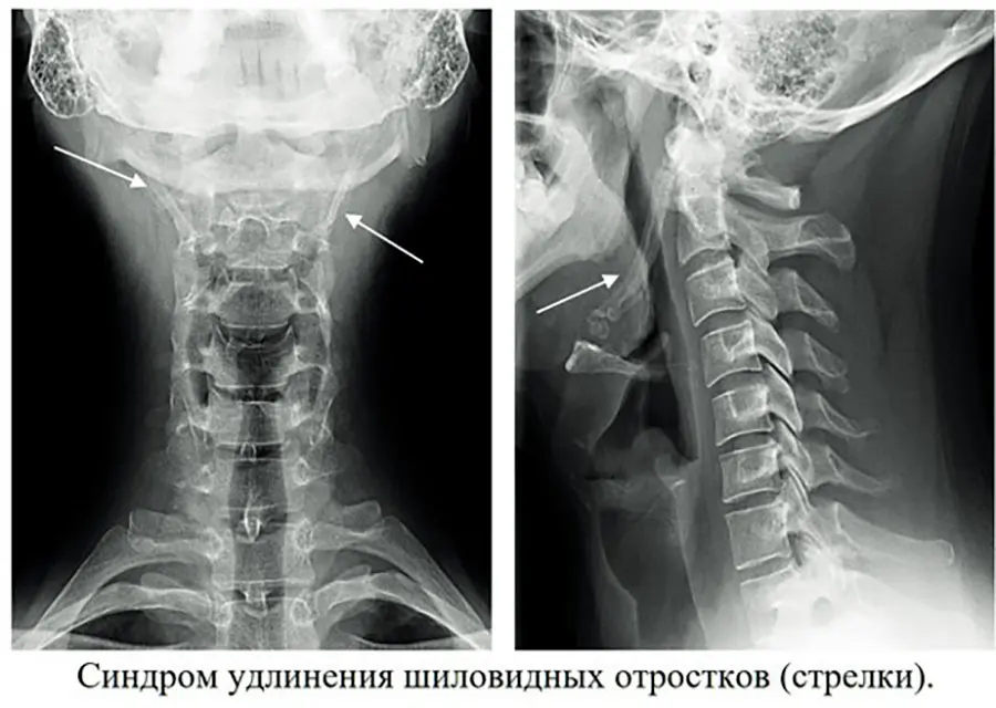 Боль в горле или синдром удлинения шиловидных отростков